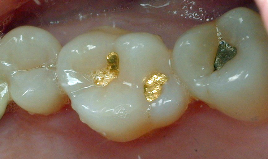 Gold dental fillings