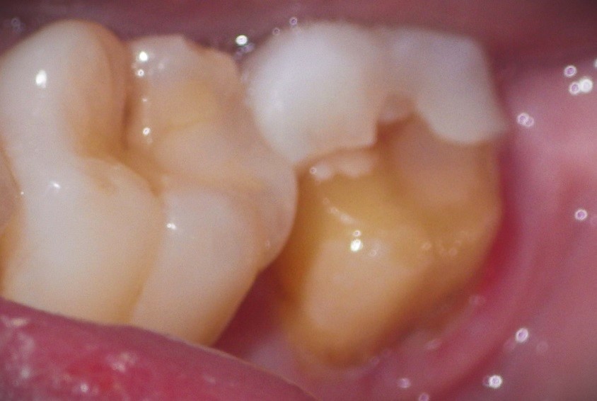Dr. Kim Henry dentist diagnoses broken ceramic crown.